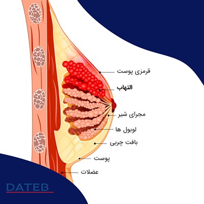 آبسه پستان