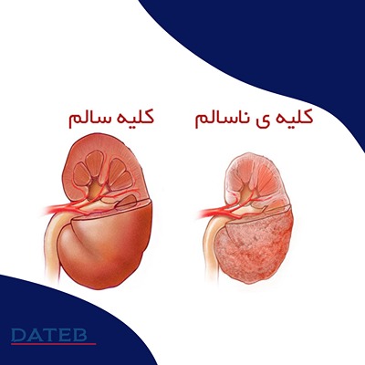 نارسایی کلیه